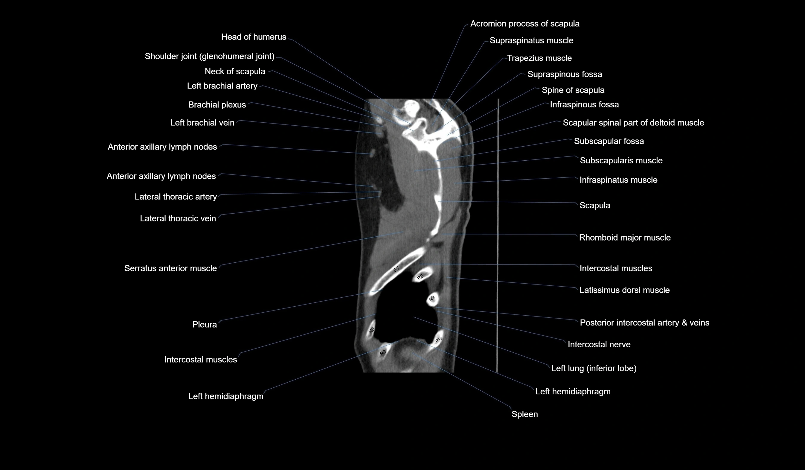 CT chest (thorax) labelled sagittal cross sectional anatomy radiology image-00131.webp